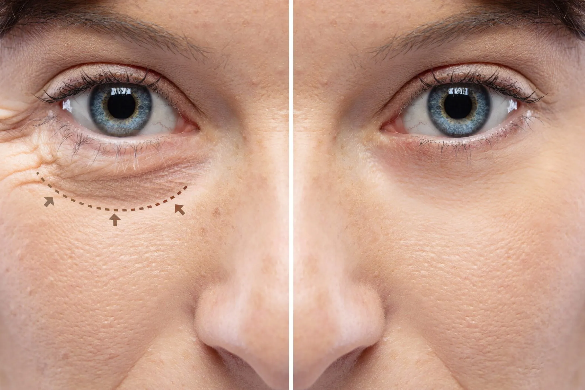 What to Expect 3 Months After Blepharoplasty