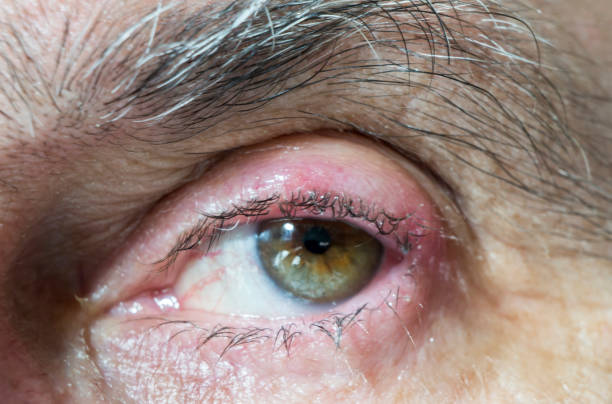 Swollen Eye