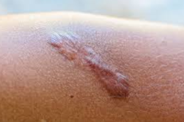 Hypertrophic Scars