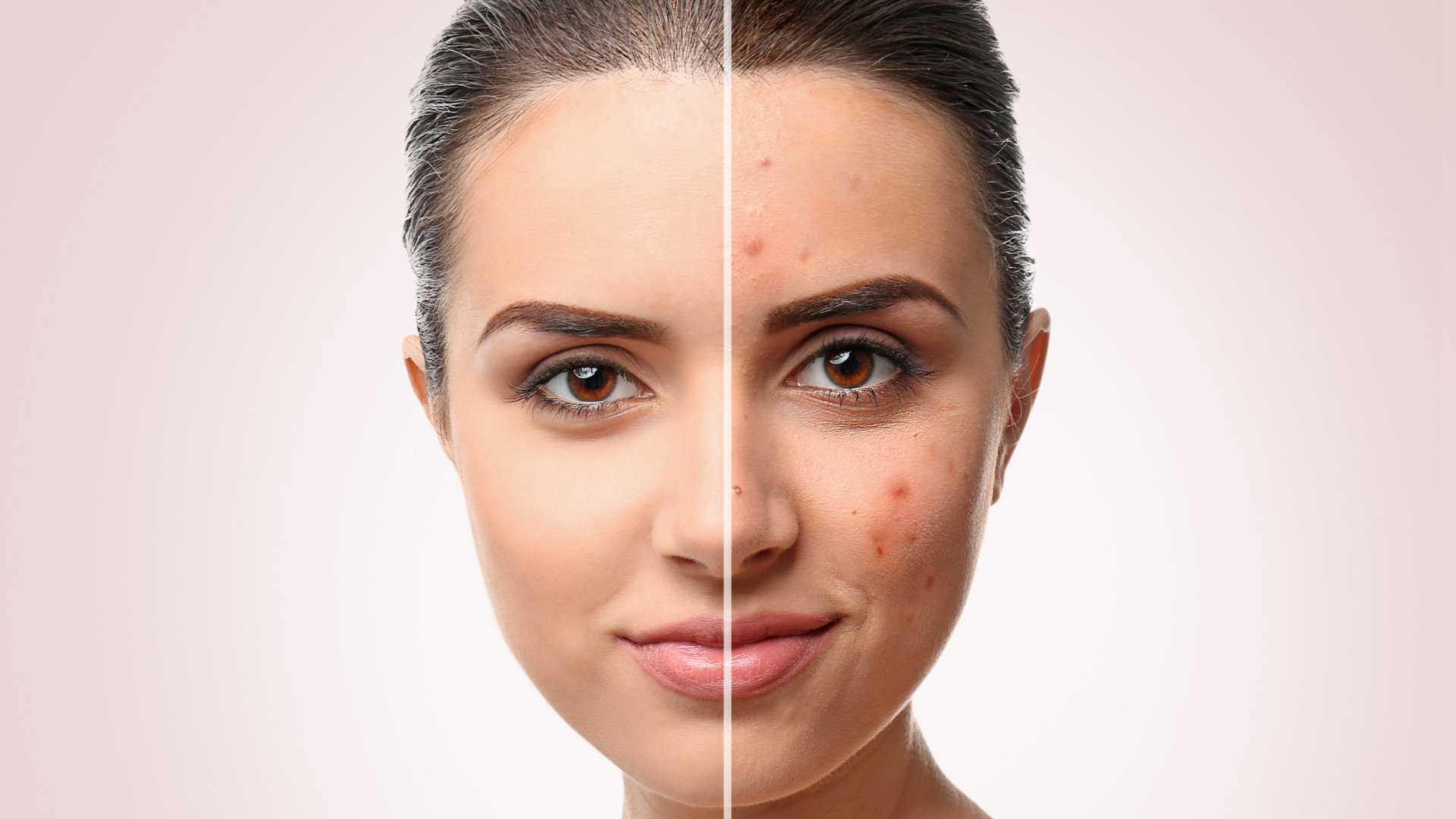 Acne Treatment 