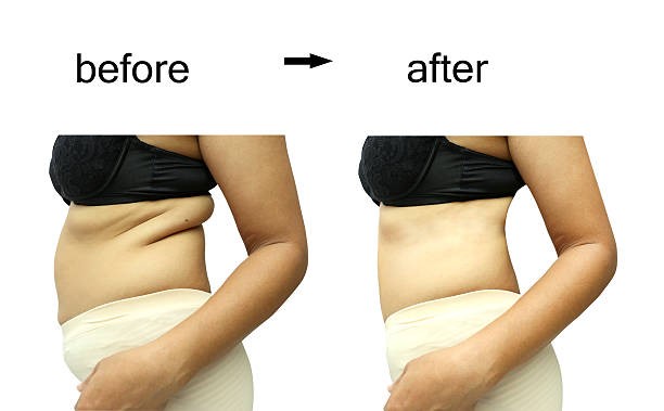 Cryolipolysis Treatment in Mumbai