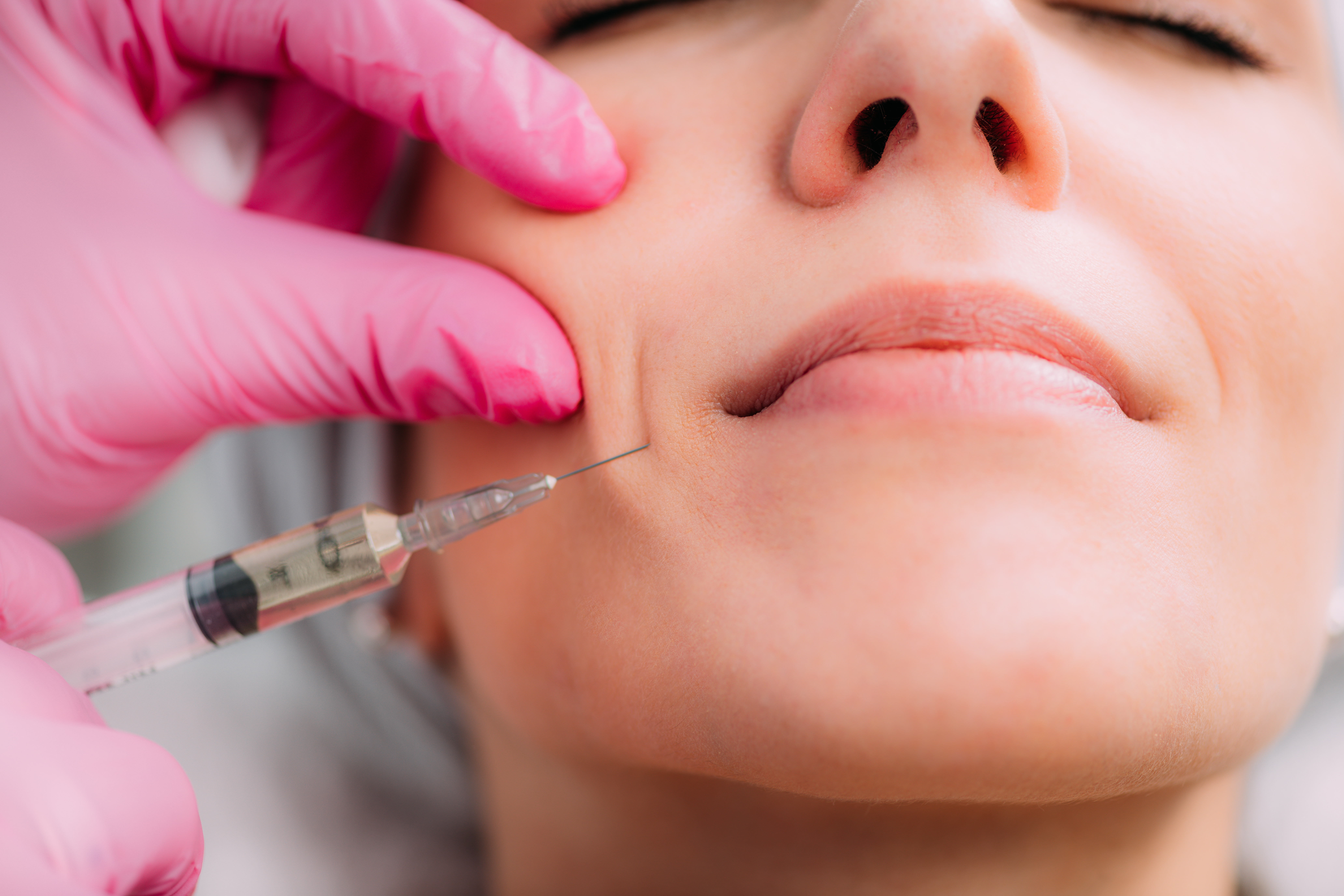 Dermal Fillers